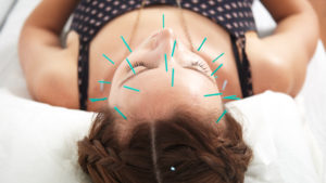 Facial Acupuncture